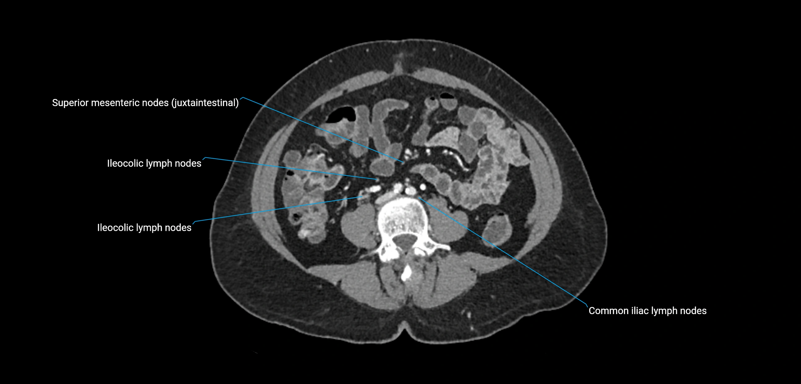 CT ct abdominal lymph nodes  axial cross sectional anatomy  enchanced radiology image -img-00002-00261.webp